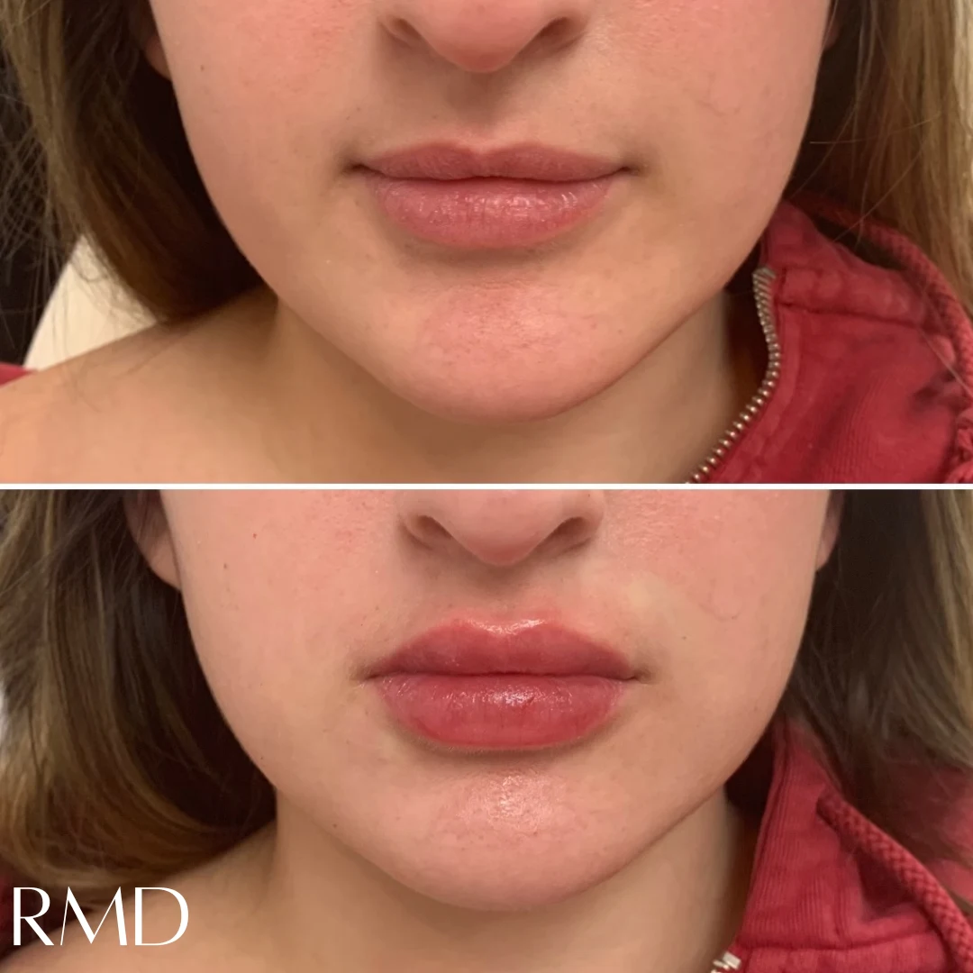 a woman's face with a comparison of her lips after dermal filler in Northborough, MA