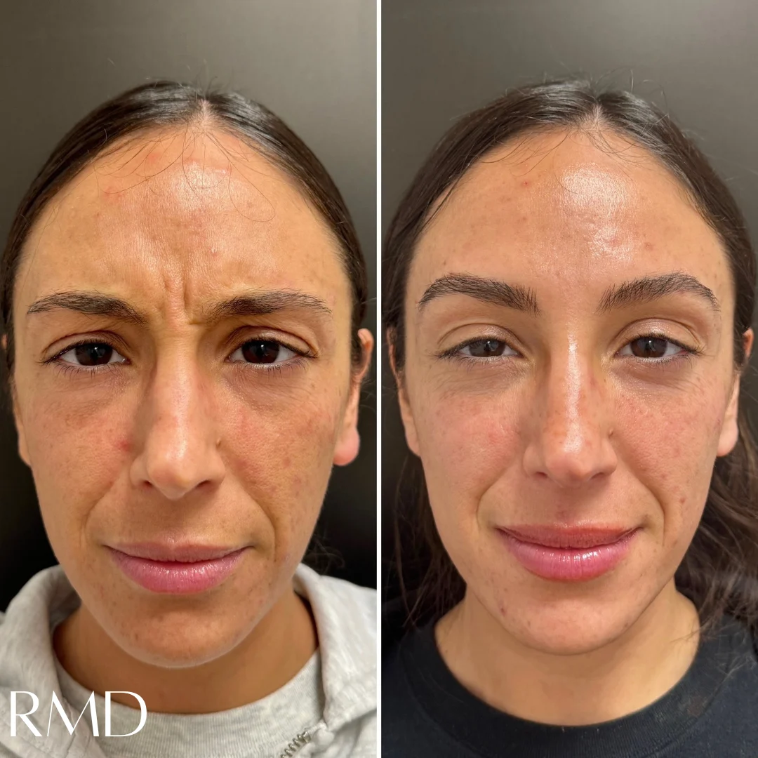 A comparison of a woman's face comparing her skin and after in Northborough, MA
