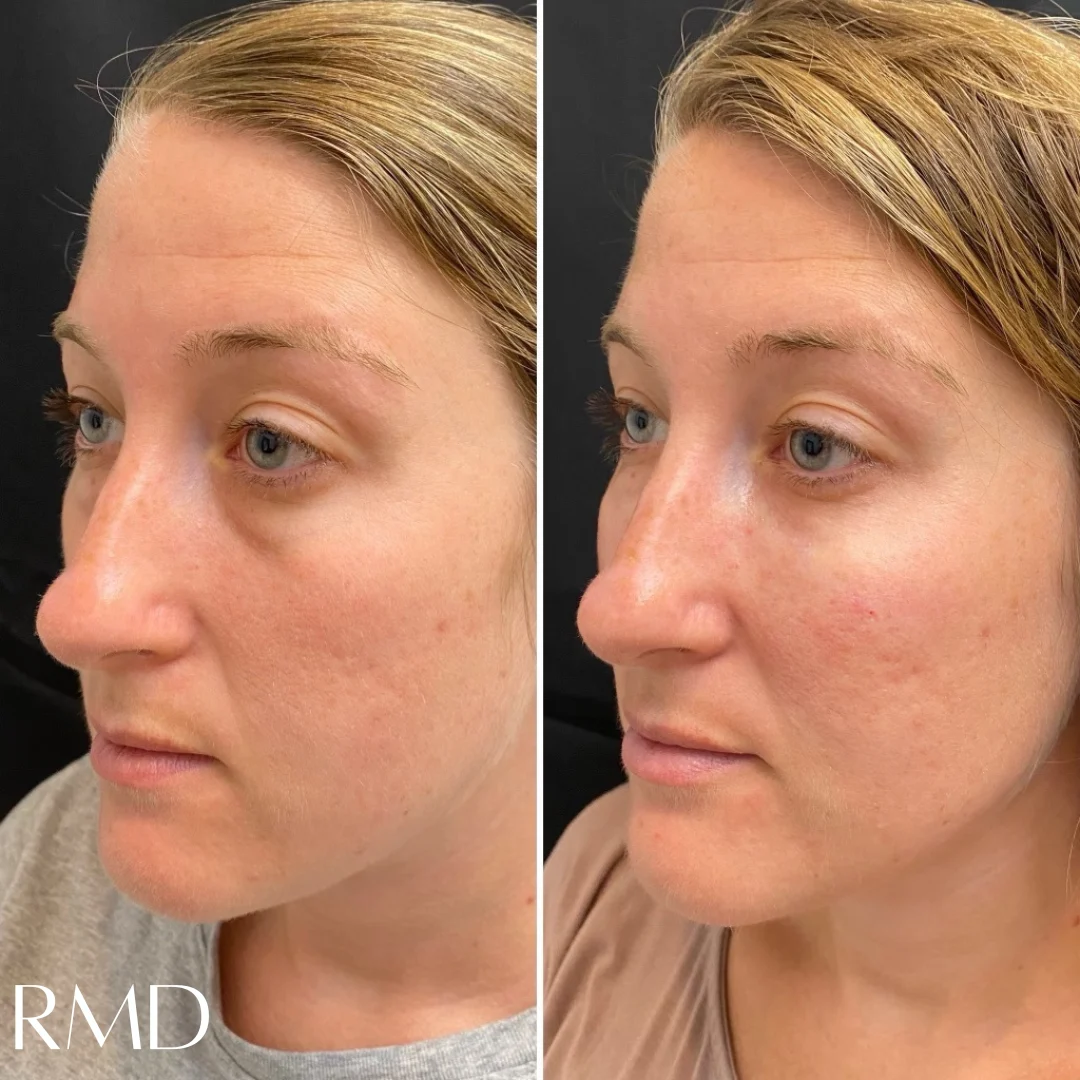 a woman with a comparison of her face in Northborough, MA