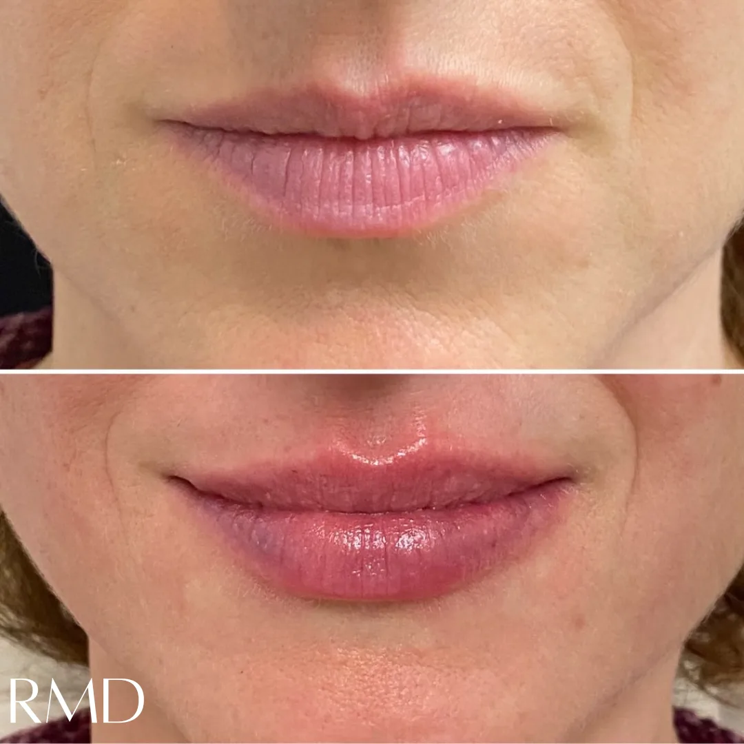 a close up of a woman's lips in Northborough, MA