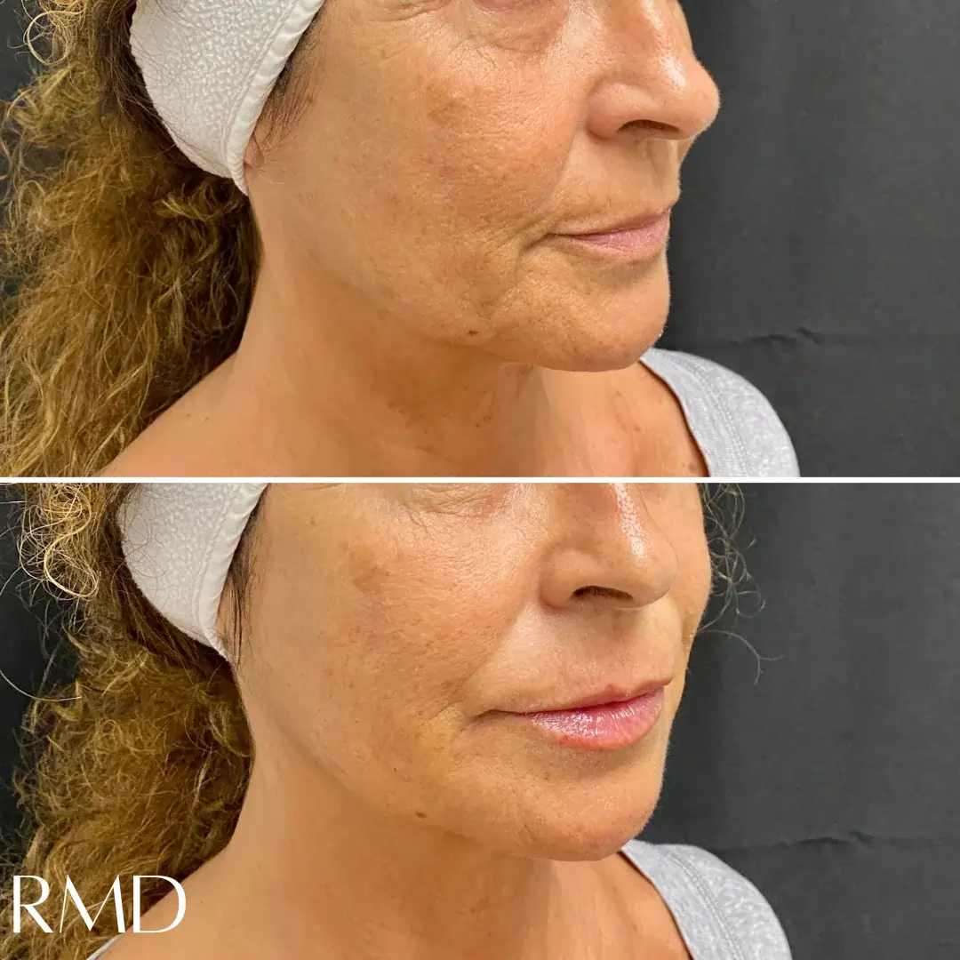 a woman with before and after images in Northborough, MA