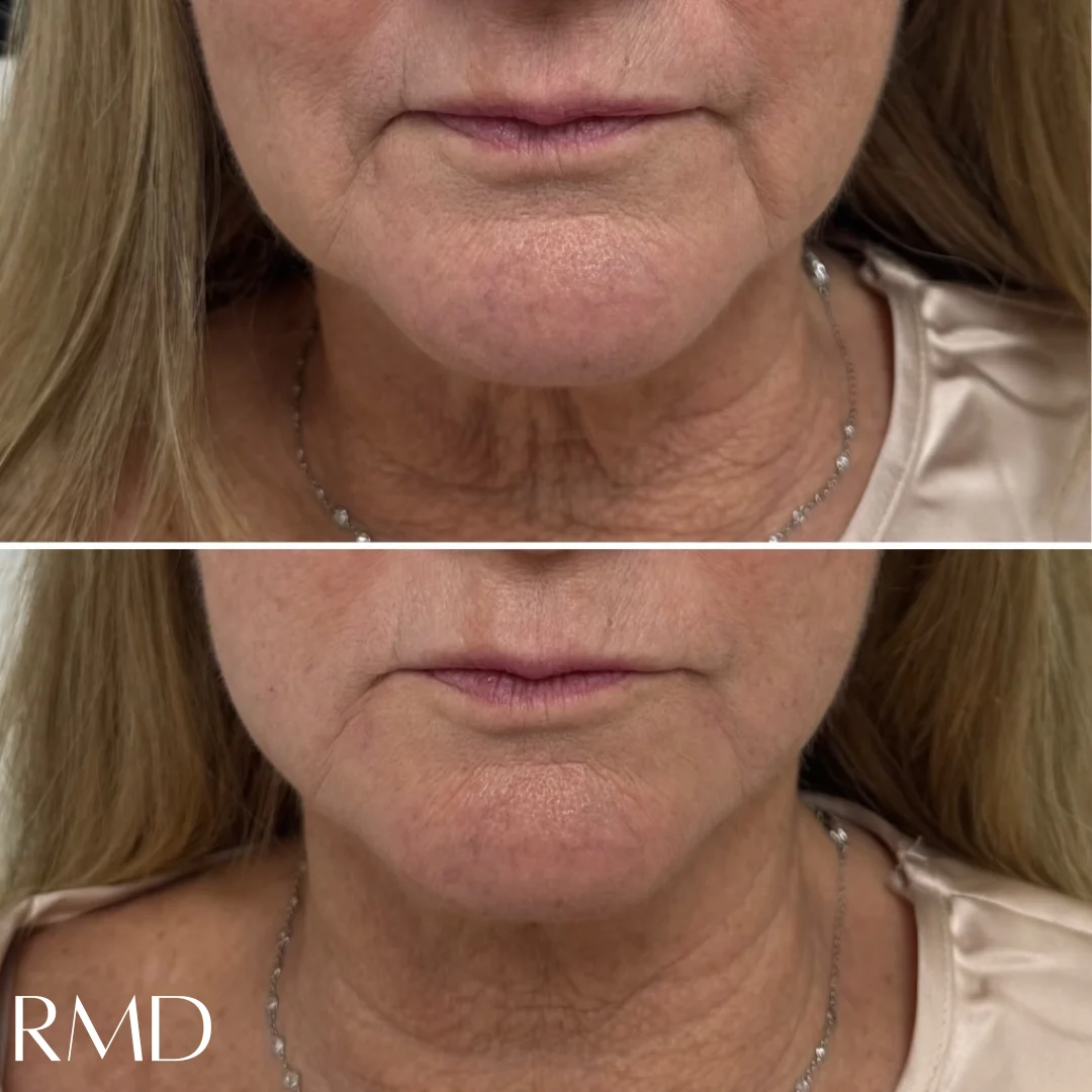 a woman with a neck and chin in Northborough, MA