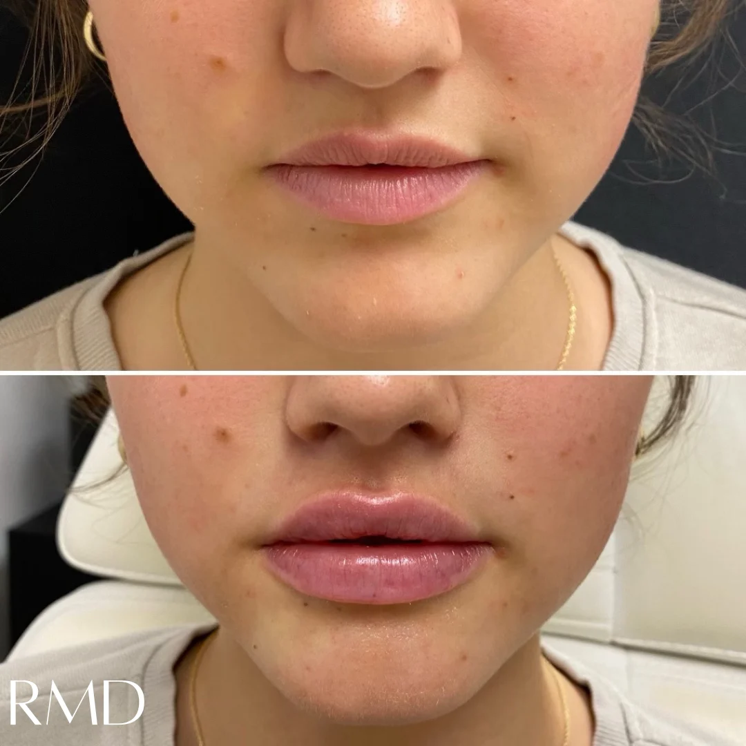 a woman's face with a few lips in Northborough, MA