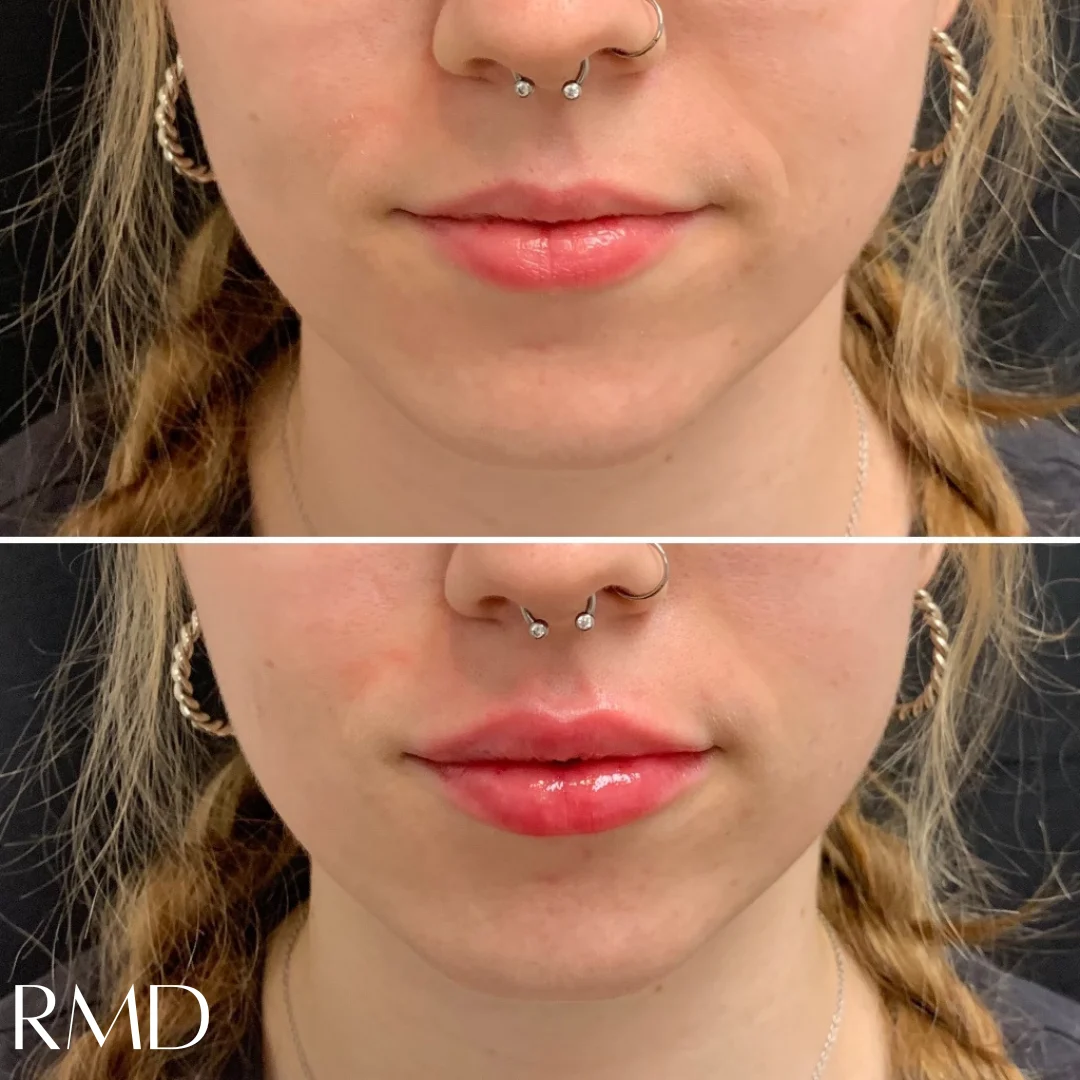 a woman before and after getting dermal fillers in Northborough, MA