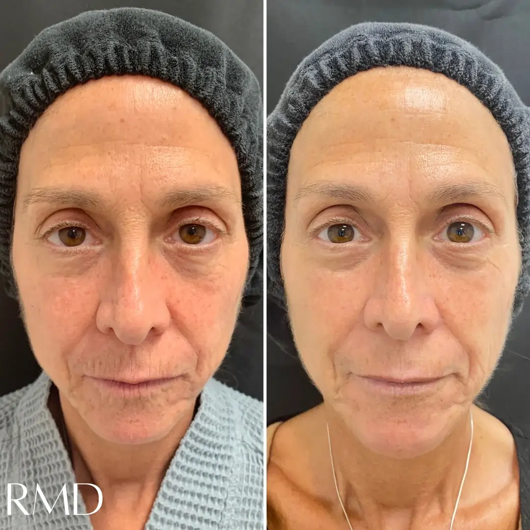 a woman before and after in Northborough, MA