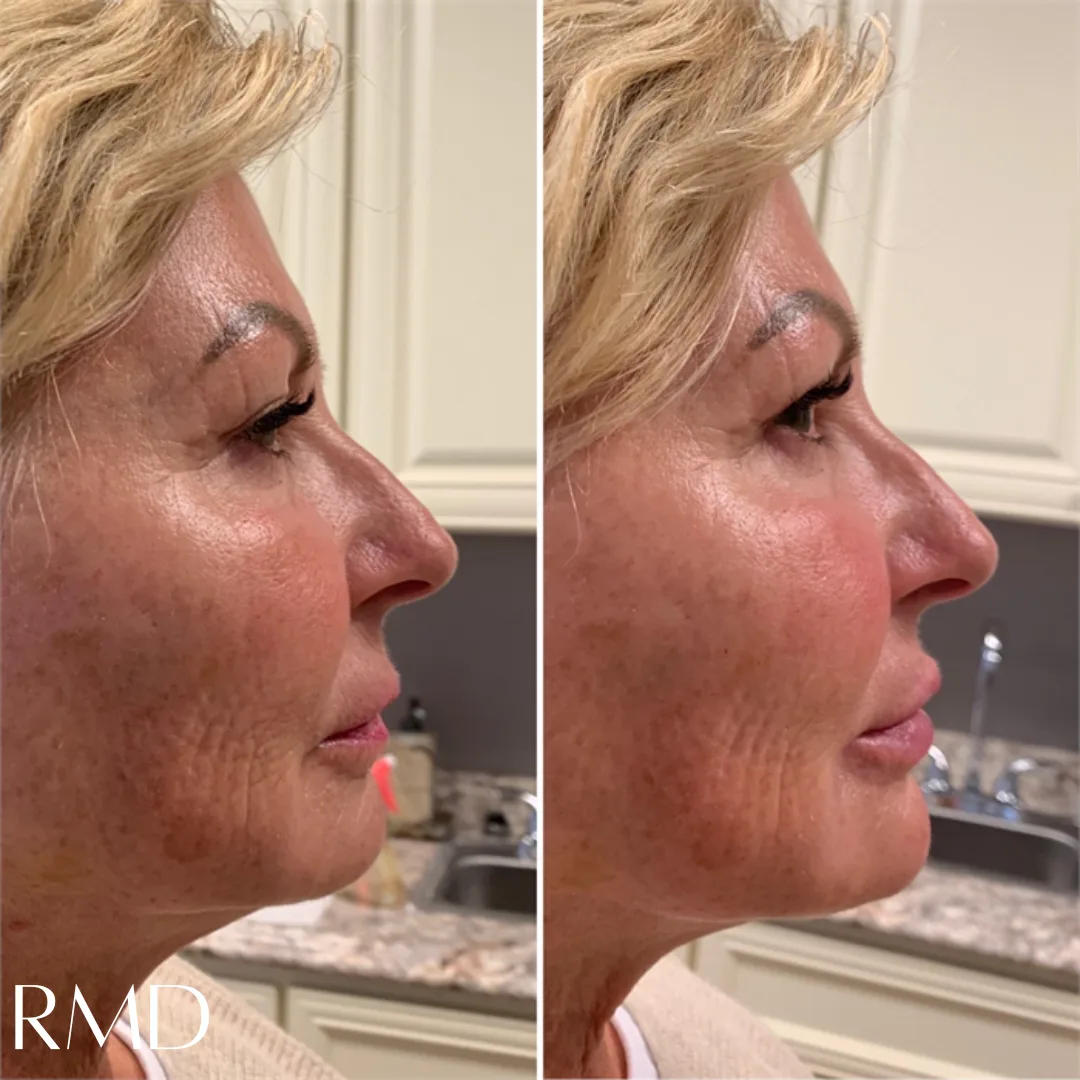 a woman showing her face before and after in Northborough, MA