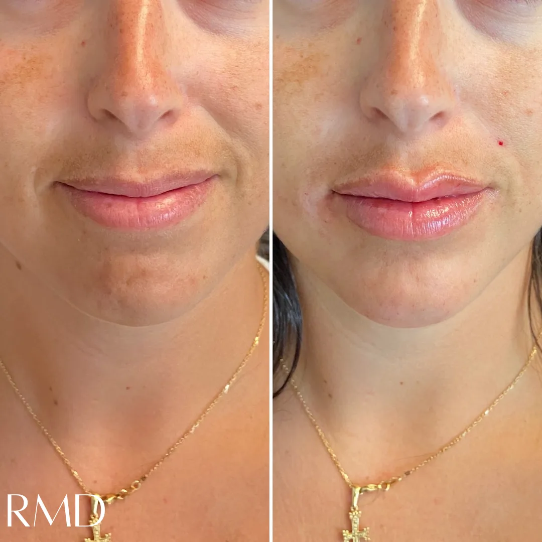 a woman with her before and after lips in Northborough, MA