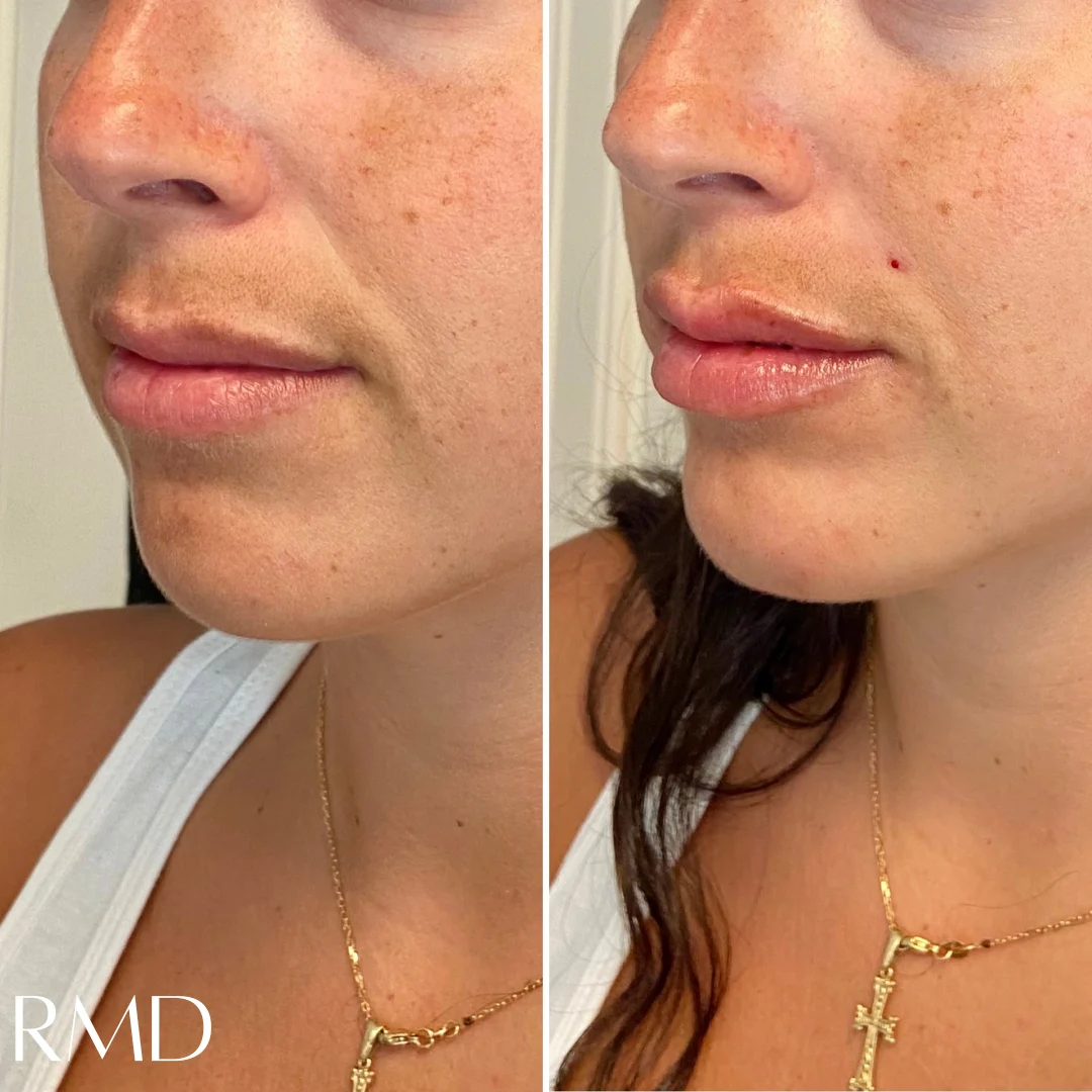 a woman with her before and after lips in Northborough, MA
